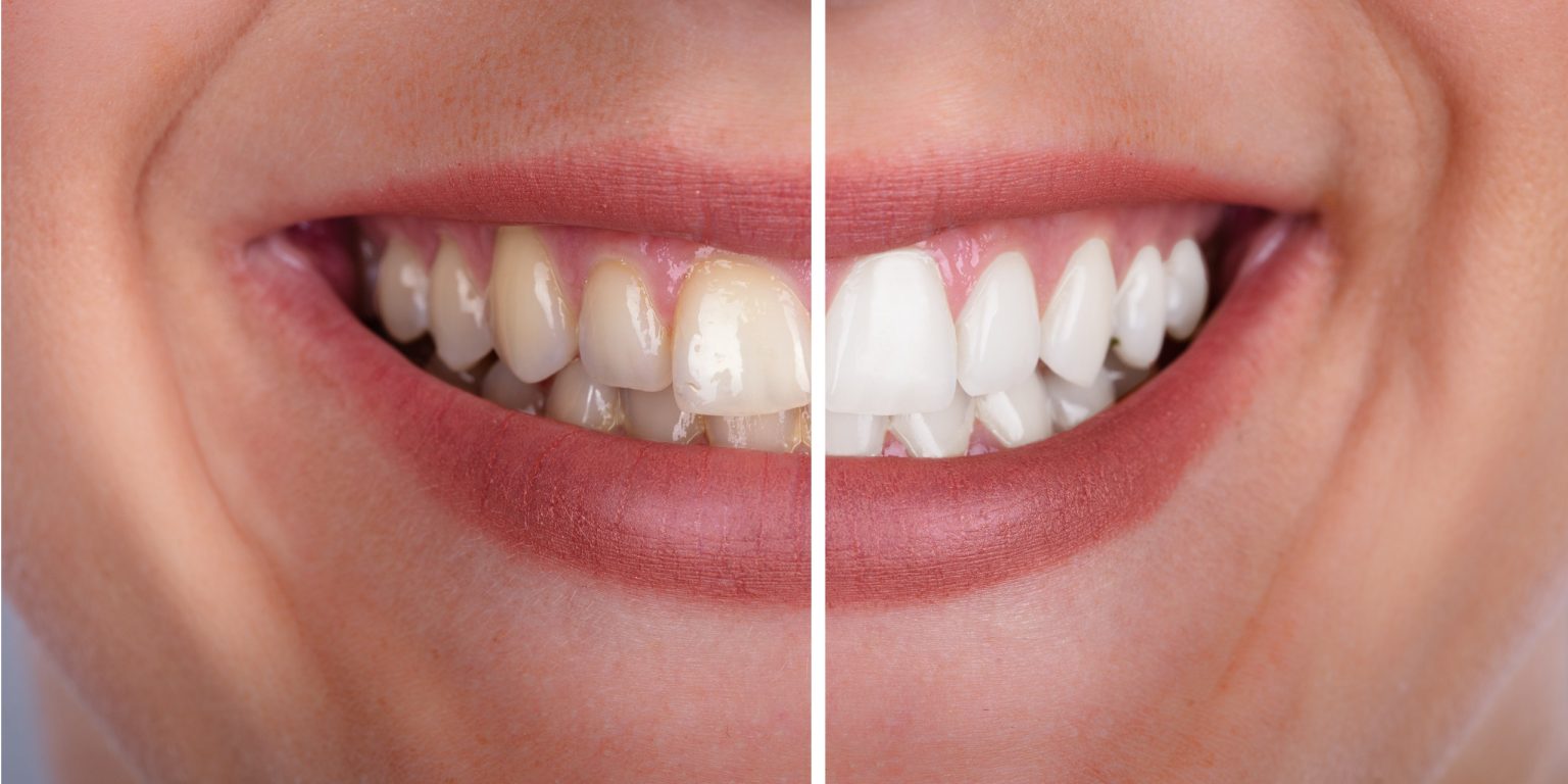 Zähne aufhellen Wie geht das? Team Dental