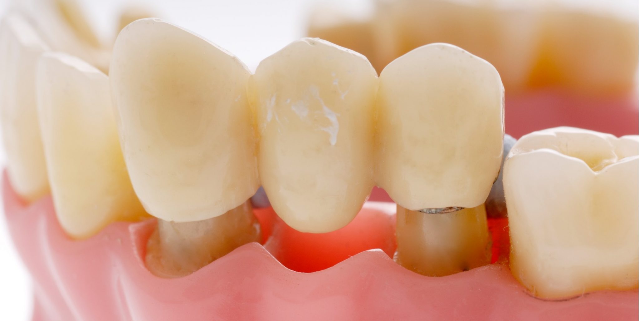 Zahnersatz: Was Ist Das Eigentlich? - Team Dental